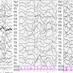 T1W images after multiple intracerebral hemorrhages at the age of 8 days. FLAIR images at age 1 year and 3 months demonstrate encephalomalacia most marked in the right parietal lobe as well as left frontal atrophy.